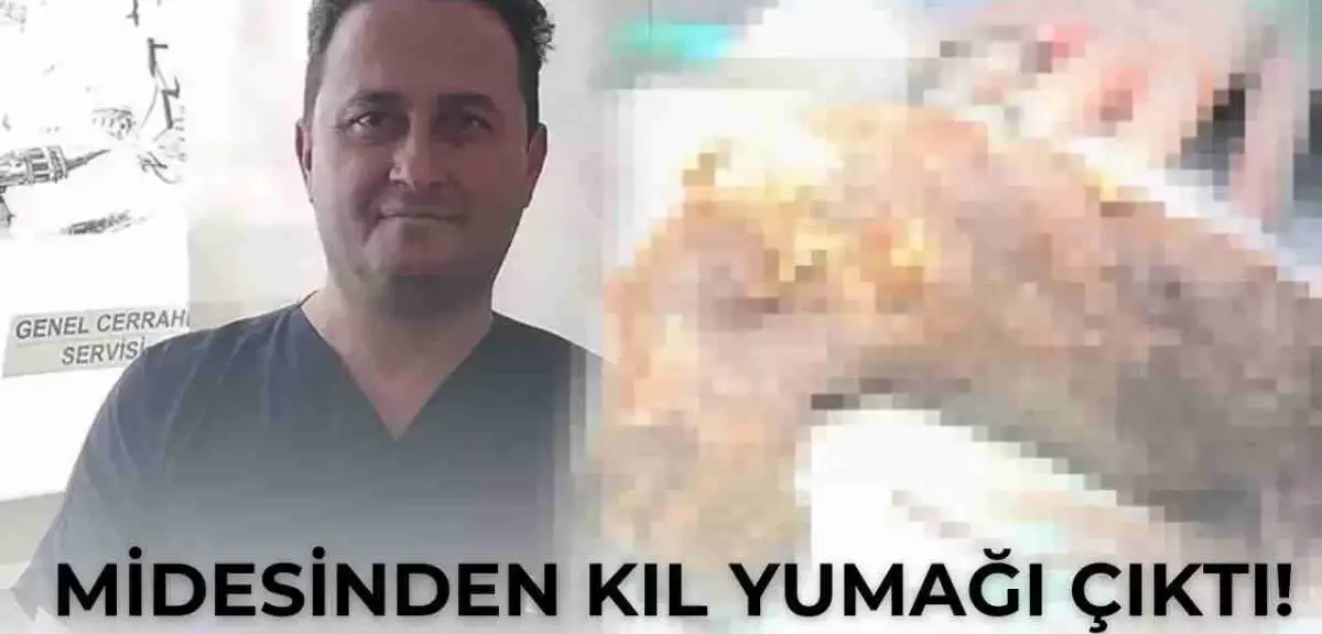 Midesinden Kıl Yumağı Çıktı! Doktorlar Gördüğüne İnanamadı!