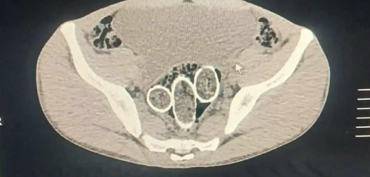 Uyuşturucuyu Cinsel Organlarında ve Midelerinde Gizleyen 3 Kişi Tutuklandı