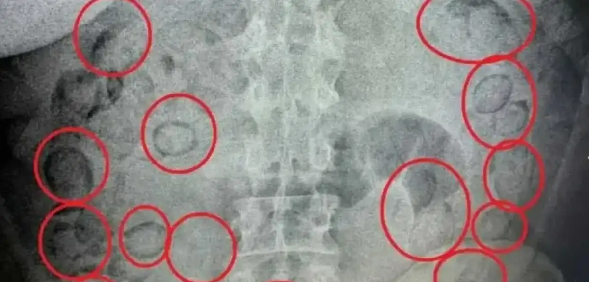 Aksaray'da Şüphelinin Midesinden Yarım Kilo Uyuşturucu Çıkarıldı