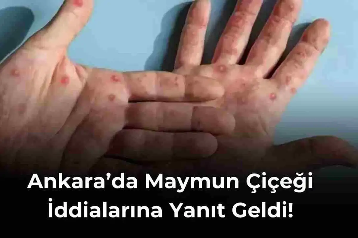 Ankara İl Sağlık Bakanlığı’ndan Açıklama Geldi! Ankara’da Maymun Çiçeği Görüldü İddialarını Yanıtladı!
