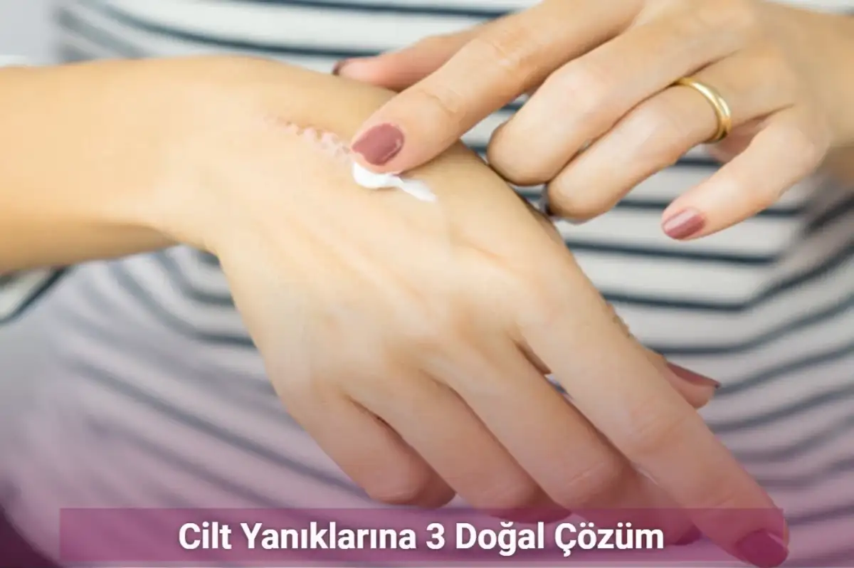 Cilt Yanıklarına 3 Doğal Çözüm
