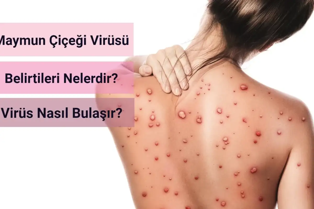 Maymun Çiçeği Virüsü Belirtileri Nelerdir?