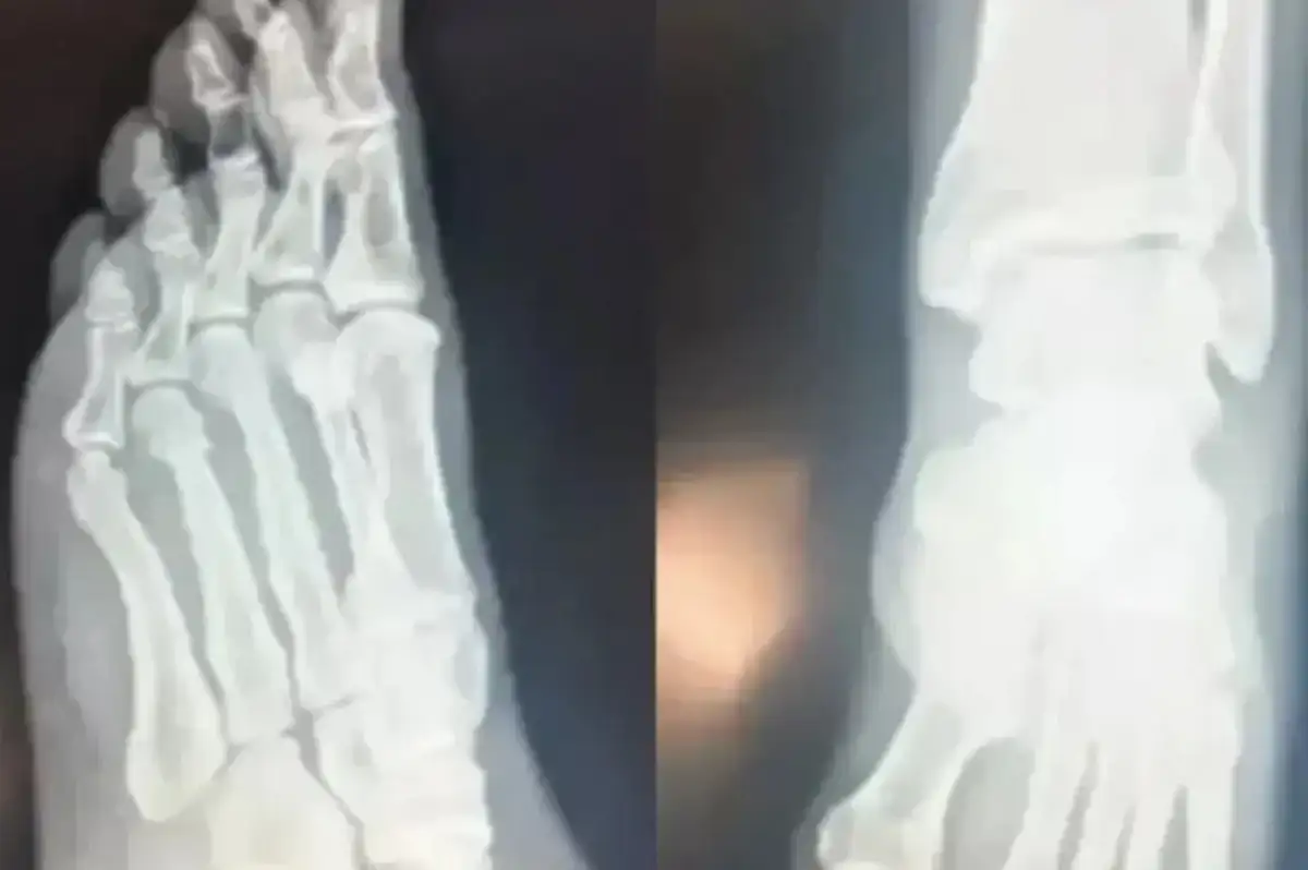 Özgür Özel Daha Fazla Dayanamadı! Röntgen Filmlerini Paylaştı
