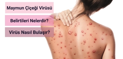Maymun Çiçeği Virüsü Belirtileri Nelerdir?