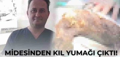 Midesinden Kıl Yumağı Çıktı! Doktorlar Gördüğüne İnanamadı!