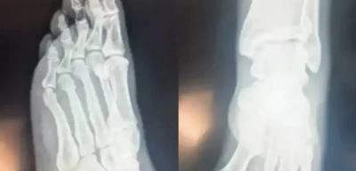Özgür Özel Daha Fazla Dayanamadı! Röntgen Filmlerini Paylaştı