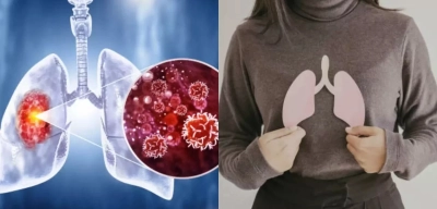 Sigara İçmeyen Kadınlarda Akciğer Kanseri Vakaları Artıyor; İşte Nedeni