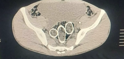 Uyuşturucuyu Cinsel Organlarında ve Midelerinde Gizleyen 3 Kişi Tutuklandı