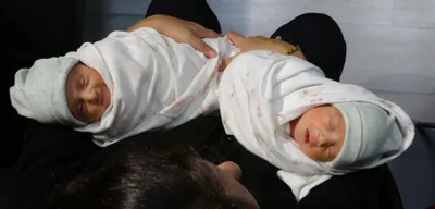 Dünyada üçüncü vaka: Trabzon'da milyonda bir görülen doğum